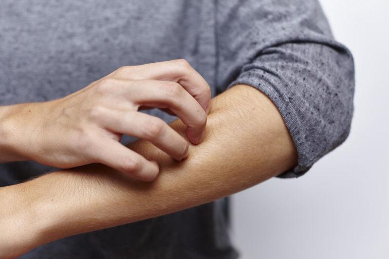 Démangeaison-psoriasis Démangeaison et psoriasis