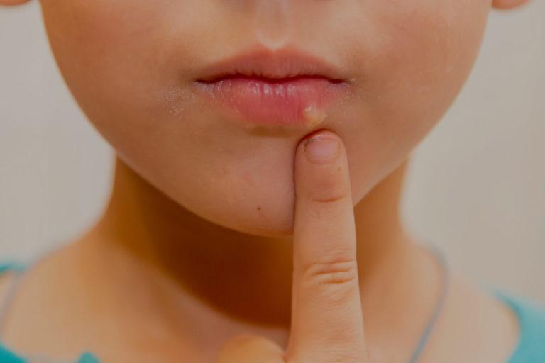 herpes Zoom sur une bouche et ayant un herpes sur la lèvre inférieure